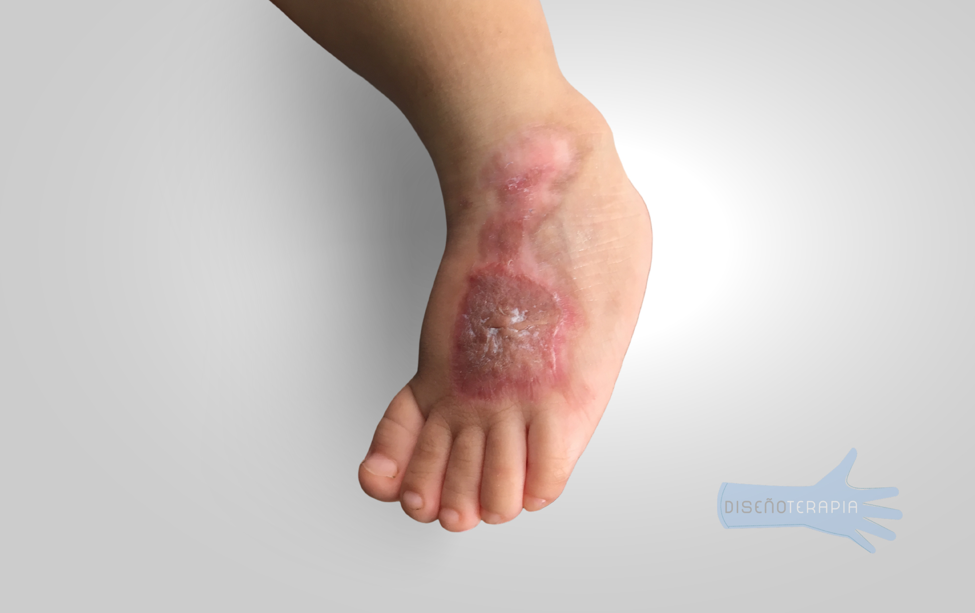 Prendas de compresión post quemaduras - Imagen 2